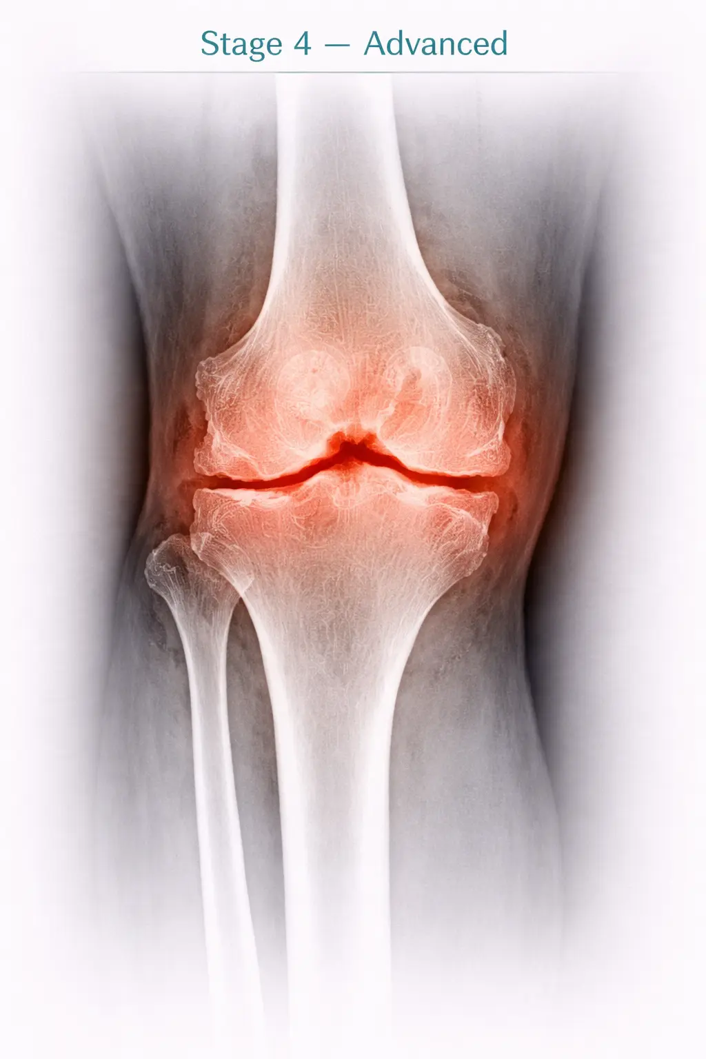Stage 4 - Advanced osteoarthritis in knee joint X-ray